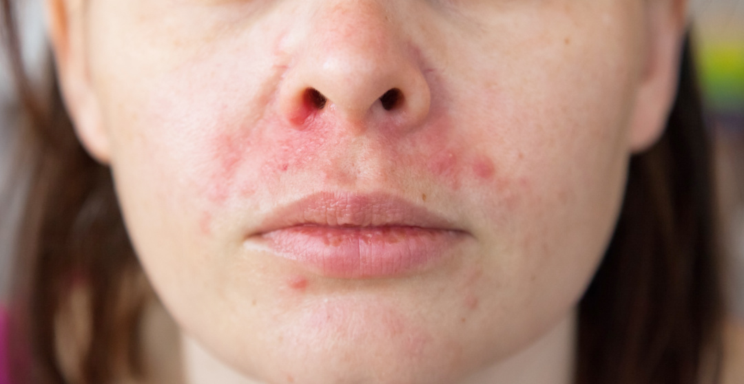 脂漏性皮膚炎の症状例