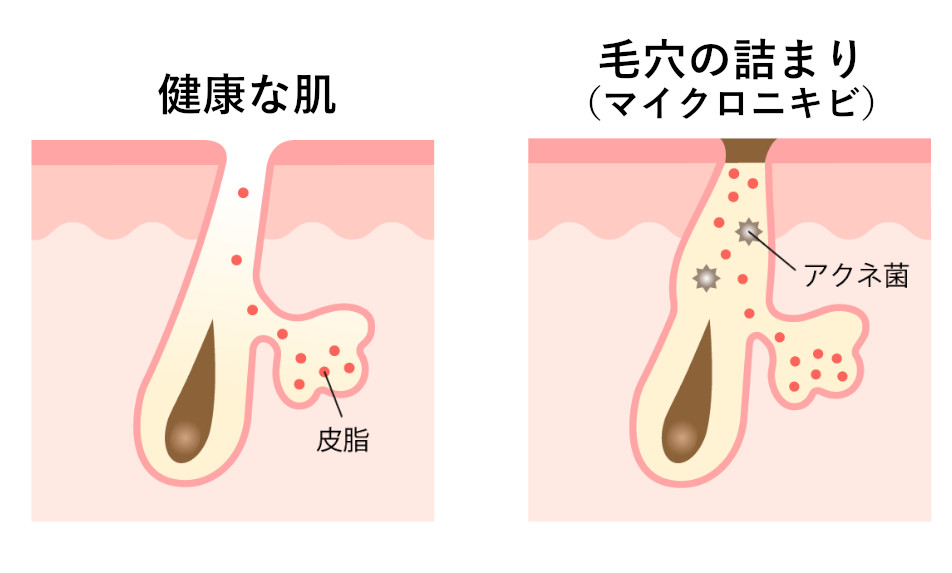 ニキビのできる原因：毛穴の詰まりの模式図
