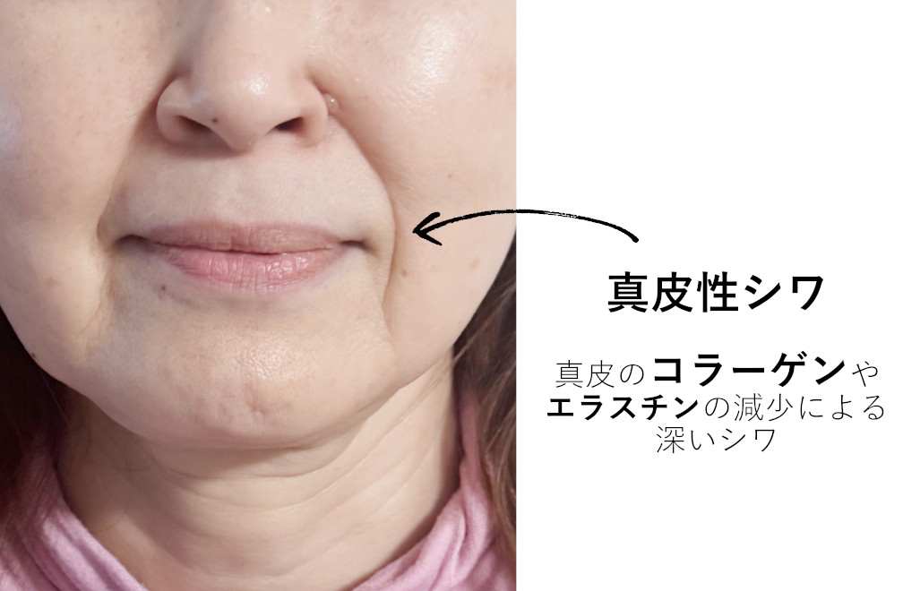 真皮性シワの写真ほうれい線