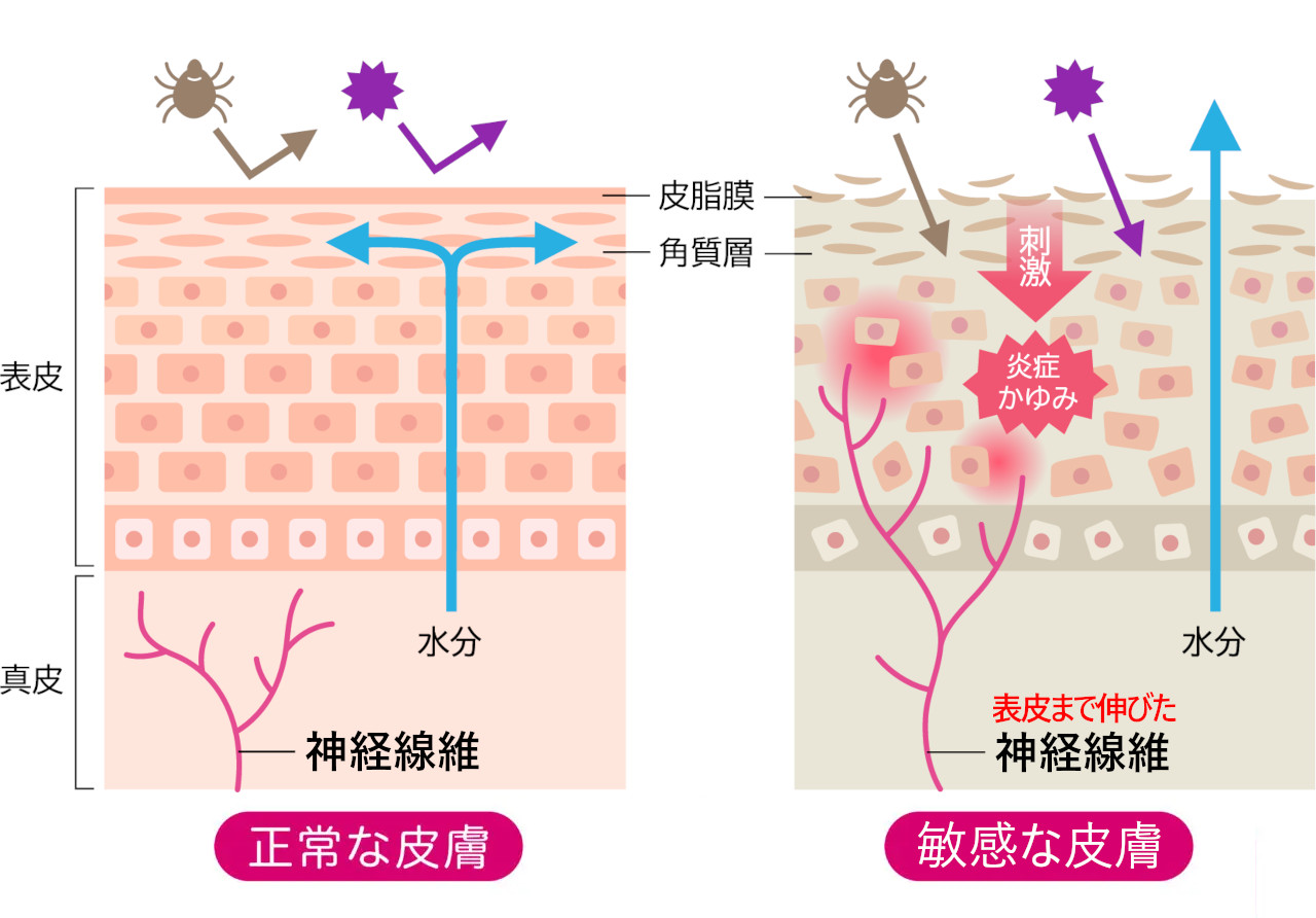 健康な肌の神経線維と、表皮まで神経線維が伸びた敏感肌の模式図