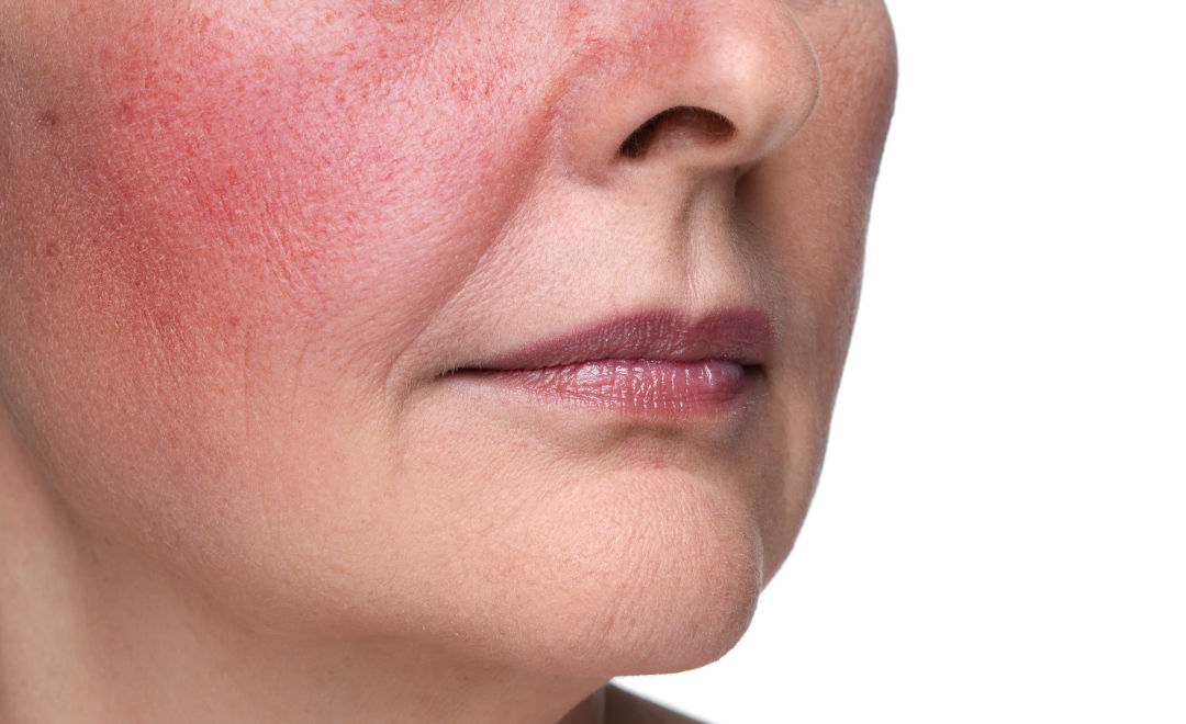 第1度:紅斑毛細血管拡張型酒さ